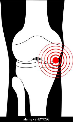 Symbol für Gelenkschmerzen. Knie-Arthrose. Schwarz-weißes Symbol. Knochen eines menschlichen Beins. Verletzungsgelenk. Arthritis Knie. Stock Vektor