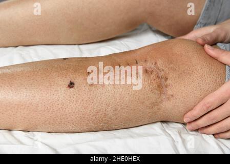 Postoperative Naht am Bein der Frau. Nahaufnahme der Narbe nach einer Kniefraktur. Spuren von unterbrochenen Nähten Bein nach der Operation. Erholung und Wundheilung Stockfoto