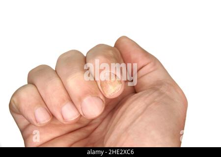 Nagelpilzprobe auf einem Handfinger. Ein Beispiel für die Gesundheit von Nagel und Haut. Das Bild mit einer Handfläche befindet sich auf einem klaren weißen Hintergrund. Stockfoto