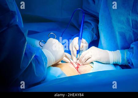 Selektiver Fokus auf die Hände von Chirurgen, die während der Operation sterile Handschuhe tragen. Ärzte schneiden die Haut des Patienten mit einem elektrischen Koagulator. Stockfoto