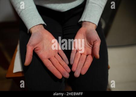 Hände einer Person mit Raynaud-Phänomen während des Angriffs mit einigen Fingern, die nach weißem Farbwechsel blau werden, Raynaud-Syndrom Raynaud-Syndrom Stockfoto