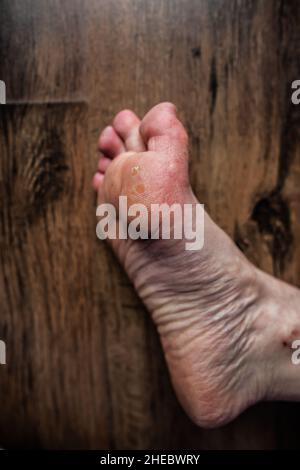 Fuß einer Person mit Raynaud- und Ehlers-Danlos-Syndrom (EDS) mit geschwollenen Zehen, beschädigter extrem trockener Risshaut, Raynaud-Phänomen-Krankheit Stockfoto