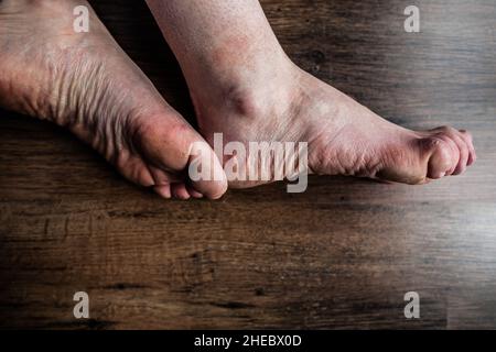 Füße einer Person mit Raynaud- und Ehlers-Danlos-Syndrom (EDS) mit geschwollenen Zehen, geschädigter, sehr trockener, gereizter Haut, Raynaud-Syndrom, Krankheitsschmerz Stockfoto