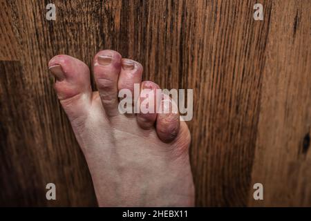 Fuß einer Person mit Raynaud- und Ehlers-Danlos-Syndrom, geschwollenen Zehen, geschädigter Haut und Nägeln, extrem trockener Haut, Raynaud-Phänomen Seltene Erkrankungen Stockfoto