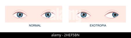 Exotropie. Horizontaler Strabismus vor und nach der Operation. Falsche Ausrichtung der Augen, Kreuzäugiger Zustand. Menschliche Augen gesund und mit Blickrichtung nach außen. Doppelblick. Vektorgrafik Cartoon-Illustration Stock Vektor