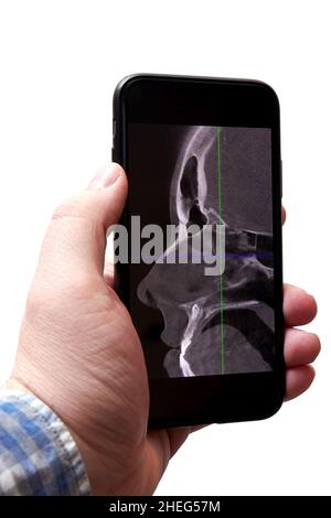 Junger Mann, der einen Röntgenscan seines Kopfes auf einem Telefon analysiert. Digitale Krankheitsdiagnose und Gesundheitstechnologien Stockfoto