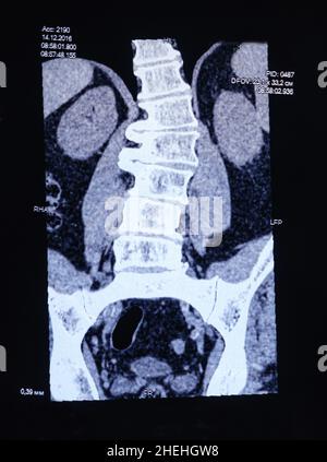 CT-Bild der Wirbelsäule eines Patienten mit Skoliose und Vorwölbung der Bandscheibe. Stockfoto