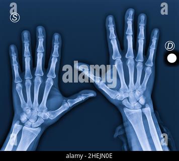 Röntgenaufnahme von Händen mit Arthritis in den Daumen Stockfoto