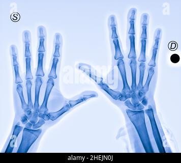 Röntgenaufnahme von Händen mit Arthritis in den Daumen Stockfoto