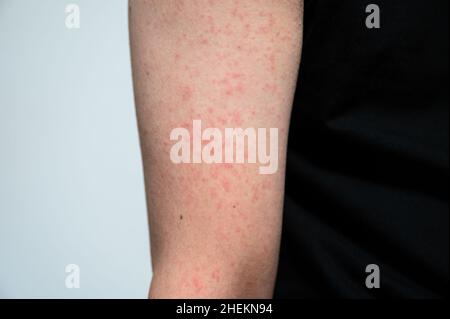 Dermatitis Hautausschlag Viruserkrankung mit Immunschwäche auf Arm von jungen erwachsenen asiatischen, Kratzer mit Juckreiz, Masern-Virus, virale Exanthem Stockfoto