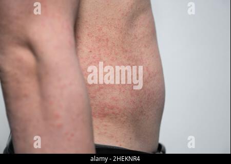 Dermatitis Hautausschlag Viruserkrankung mit Immunschwäche am Körper von jungen erwachsenen asiatischen, Kratzer mit Juckreiz, Masern-Virus, virale Exanthem Stockfoto