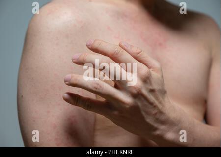 Dermatitis Hautausschlag Viruserkrankung mit Immunschwäche am Körper von jungen erwachsenen asiatischen, Kratzen mit Juckreiz, Masern-Virus, virale Exanthem Stockfoto