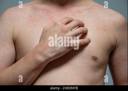 Dermatitis Hautausschlag Viruserkrankung mit Immunschwäche am Körper von jungen erwachsenen asiatischen, Kratzen mit Juckreiz, Masern-Virus, virale Exanthem Stockfoto