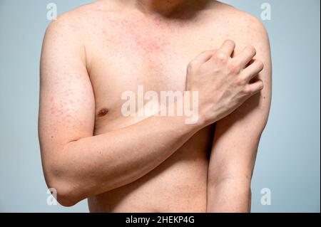 Dermatitis Hautausschlag Viruserkrankung mit Immunschwäche am Körper von jungen erwachsenen asiatischen, Kratzen mit Juckreiz, Masern-Virus, virale Exanthem Stockfoto