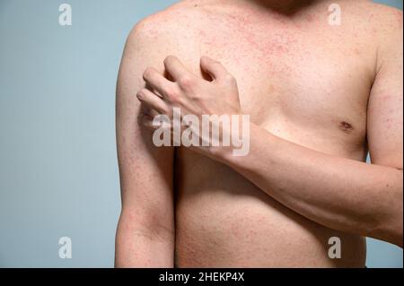 Dermatitis Hautausschlag Viruserkrankung mit Immunschwäche am Körper von jungen erwachsenen asiatischen, Kratzen mit Juckreiz, Masern-Virus, virale Exanthem Stockfoto