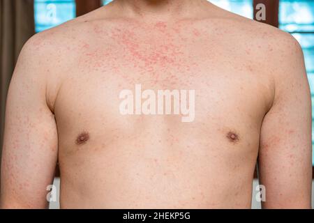 Dermatitis Hautausschlag Viruserkrankung mit Immunschwäche am Körper von jungen erwachsenen asiatischen, Kratzer mit Juckreiz, Masern-Virus, virale Exanthem Stockfoto