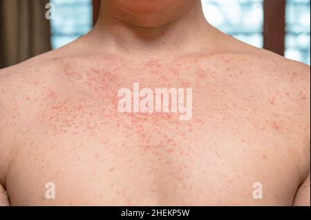 Dermatitis Hautausschlag Viruserkrankung mit Immunschwäche am Körper von jungen erwachsenen asiatischen, Kratzer mit Juckreiz, Masern-Virus, virale Exanthem Stockfoto