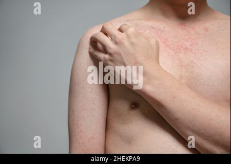 Dermatitis Hautausschlag Viruserkrankung mit Immunschwäche am Körper von jungen erwachsenen asiatischen, Kratzen mit Juckreiz, Masern-Virus, virale Exanthem Stockfoto