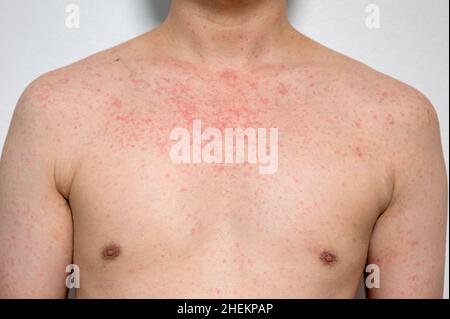 Dermatitis Hautausschlag Viruserkrankung mit Immunschwäche am Körper von jungen erwachsenen asiatischen, Kratzer mit Juckreiz, Masern-Virus, virale Exanthem Stockfoto