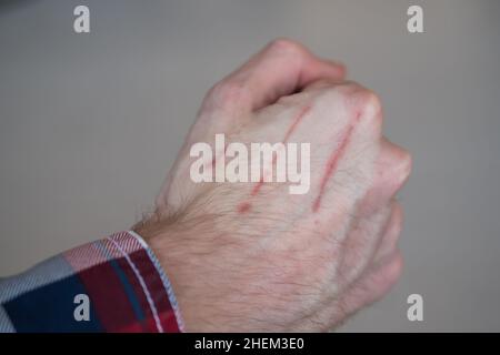 Nahaufnahme des Mannes, der die Hand mit Kratzern auf der Haut zeigt Stockfoto