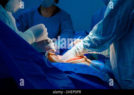 Ein Team von Chirurgen führt eine chirurgische Operation an der Bauchhöhle des Patienten durch. Selektiver Fokus. Hände von Ärzten in weißen sterilen Handschuhen während einer Operation. Stockfoto