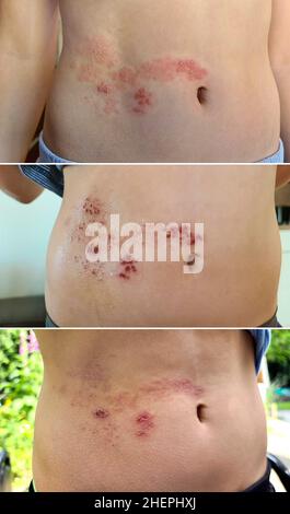 Entwicklung der Gürtelrose Ausschlag auf den Bauch Stockfoto