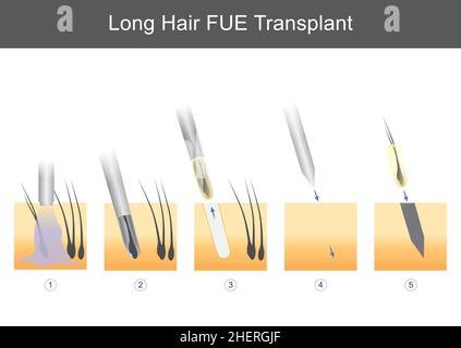 Lange Haar FuE-Transplantation. Abbildung für medizinische Darstellung technischer Schritte der Haartransplantation. Stock Vektor