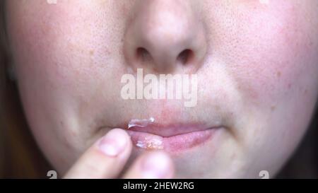 Junge Frau, die an Herpes auf den Lippen leidet. Nahaufnahme der Frau Finger Anwendung Salbe auf Lippen, Behandlung von Herpes-Infektion und Virus. Stockfoto