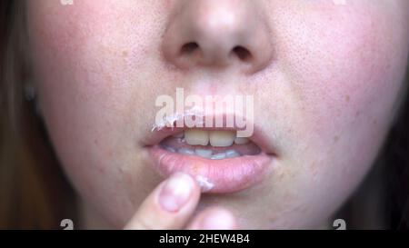 Junge Frau, die an Herpes auf den Lippen leidet. Nahaufnahme der Frau Finger Anwendung Salbe auf Lippen, Behandlung von Herpes-Infektion und Virus. Stockfoto