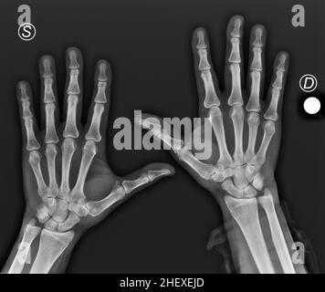 Röntgenaufnahme von Händen mit Arthritis in den Daumen Stockfoto