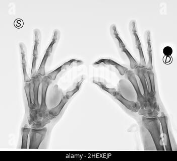 Röntgenaufnahme von Händen mit Arthritis in den Daumen Stockfoto