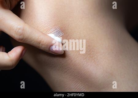Marken nach Laser-Haar oder atopische Ekzeme Entfernung von Narben von der Haut. CO2 Technik. Stockfoto