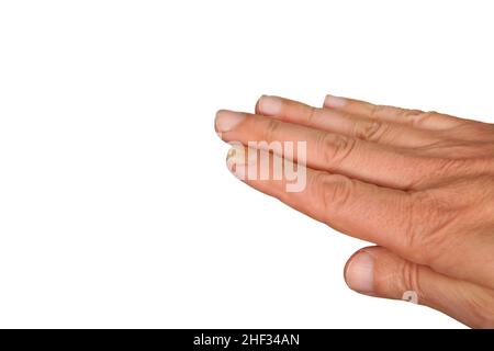 Nagelmykose, Pilzsymptome an einem Handfinger. Ein Beispiel für Nagelonychomykose in der Nahaufnahme. Ein Palmenfoto befindet sich auf einem klaren weißen Hintergrund. Stockfoto