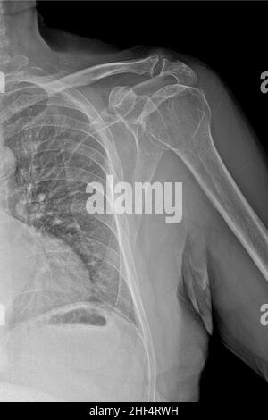 Radiographie des Schultergelenks, nach Trauma Stockfoto