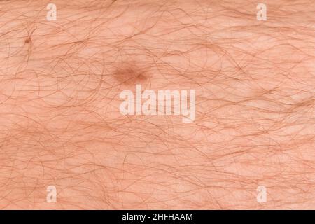 Rote Wunde auf der Haut des haarigen Beins eines Mannes, Nahaufnahme. Stockfoto