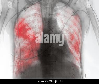 Röntgenbild eines Patienten mit Lungenentzündung in der frühen postoperativen Phase. Stockfoto