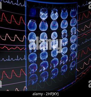 CT-Film und EKG-Überwachung als medizinisches Konzept zur Früherkennung von Gefäßerkrankungen. Stockfoto