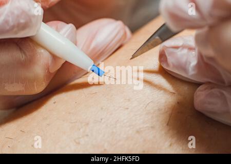 Der Prozess der dauerhaften Haarentfernung, der Entfernung unerwünschter Haare mit einem Elektroepiliergerät und einer Pinzette, Nahaufnahmen von Makroaufnahmen. Stockfoto