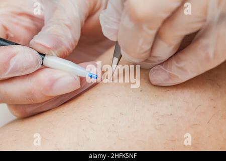 Der Prozess der dauerhaften Haarentfernung, der Entfernung unerwünschter Haare mit einem Elektroepiliergerät und einer Pinzette, Nahaufnahmen von Makroaufnahmen. Stockfoto