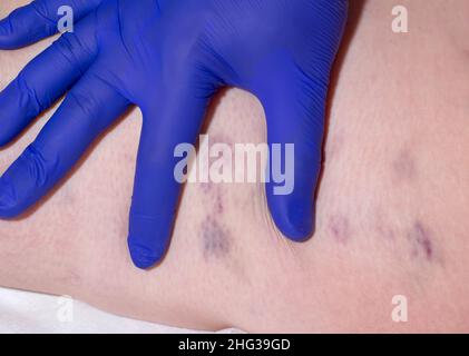 Der Arzt untersucht das Bein eines Patienten mit Krampfadern und Venenthrombose. Behandlung von Krampfadern Stockfoto