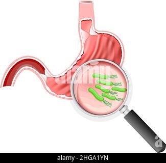 Helicobacter pylori-Bakterien. Magen mit Magengeschwüren und Vergrößerungsglas. Vektorgrafik Stock Vektor