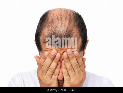 Close-uo von Glatze Mann durch schnellen Haarausfall vor weißem Hintergrund betont Stockfoto