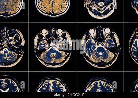 MRT-Bild der Nahaufnahme des menschlichen Gehirns. Stockfoto