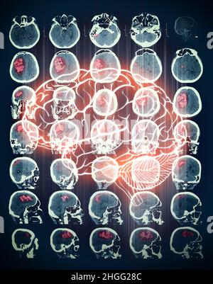 Rot markierte Zone auf dem CT-Scan des menschlichen Gehirns. Stockfoto