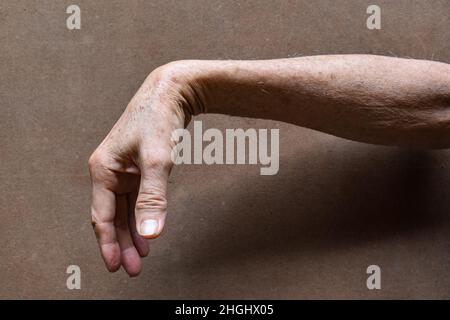 Radiale Nervenverletzung oder Abtropfen des Handgelenks eines alten asiatischen Mannes. Stockfoto