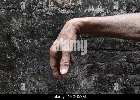 Radiale Nervenverletzung oder Abtropfen des Handgelenks eines alten asiatischen Mannes. Stockfoto