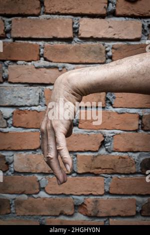 Radiale Nervenverletzung oder Abtropfen des Handgelenks eines alten asiatischen Mannes. Stockfoto