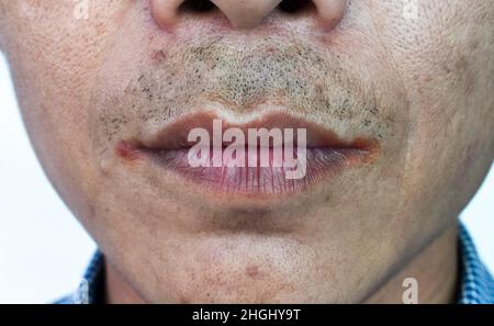 Winkelstomatitis oder Winkelcheilitis oder Perleche beim asiatischen Alkoholiker. Häufige entzündliche Erkrankung der Mundwinkel. Rissige Lippen. Stockfoto