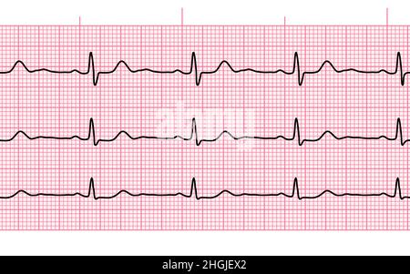 Herzschlag-ekg oder ekg nahtlose schwarze Linie auf rosa Papier. Elektrokardiogramm-Diagramm der Herz-Kreislauf-Heilungsrate. Untersuchung der menschlichen Gesundheit. Medizintestwagen Stock Vektor