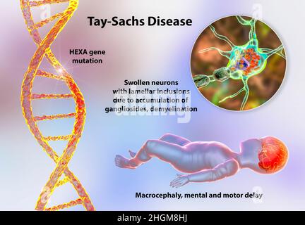 Tay-Sachs-Krankheit, Computerdarstellung Stockfoto